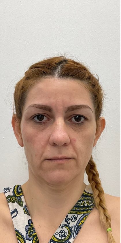 Otoplasty Before & After Patient #3095