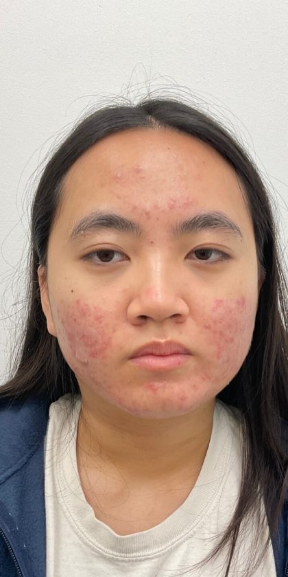 Acne Scar Removal Before & After Patient #3088