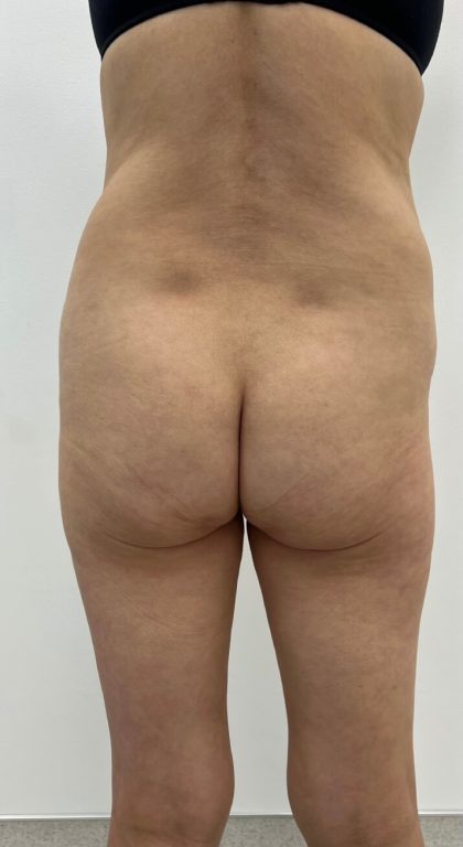 Fat Transfer Before & After Patient #3080