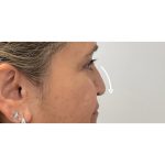 Non-Surgical Rhinoplasty Before & After Patient #3126