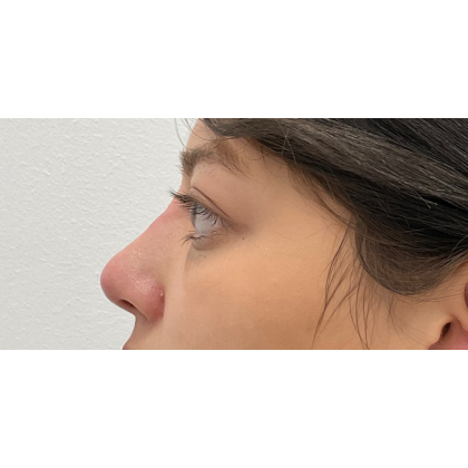 Non-Surgical Rhinoplasty Before & After Patient #3131