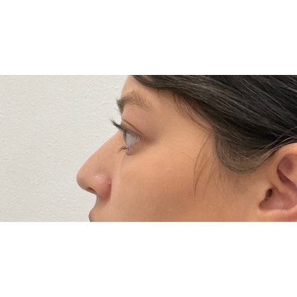 Non-Surgical Rhinoplasty Before & After Patient #3131