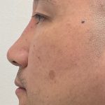 Non-Surgical Rhinoplasty Before & After Patient #3164