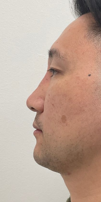 Non-Surgical Rhinoplasty Before & After Patient #3164