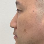 Non-Surgical Rhinoplasty Before & After Patient #3164