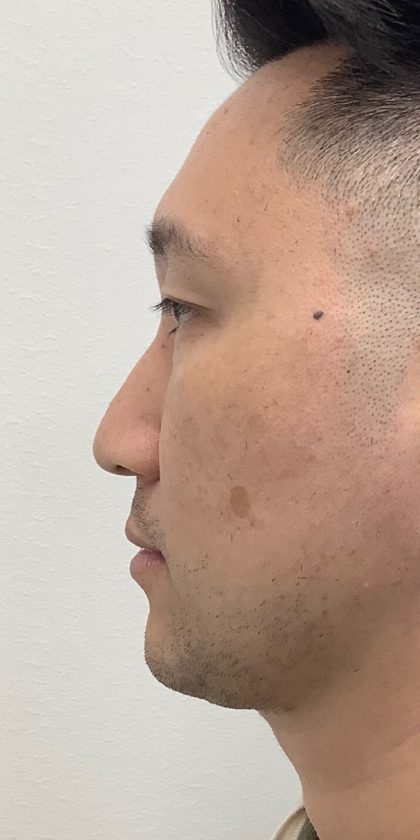 Non-Surgical Rhinoplasty Before & After Patient #3164