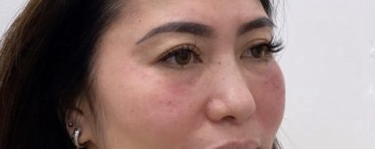 Under Eye Fillers Before & After Patient #3161