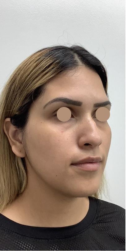 Non-Surgical Rhinoplasty Before & After Patient #3192