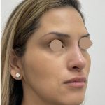 Non-Surgical Rhinoplasty Before & After Patient #3192