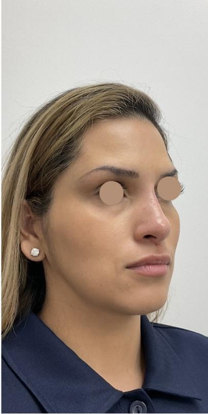 Non-Surgical Rhinoplasty Before & After Patient #3192