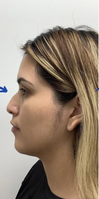 Non-Surgical Rhinoplasty Before & After Patient #3192