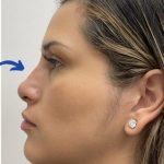 Non-Surgical Rhinoplasty Before & After Patient #3192