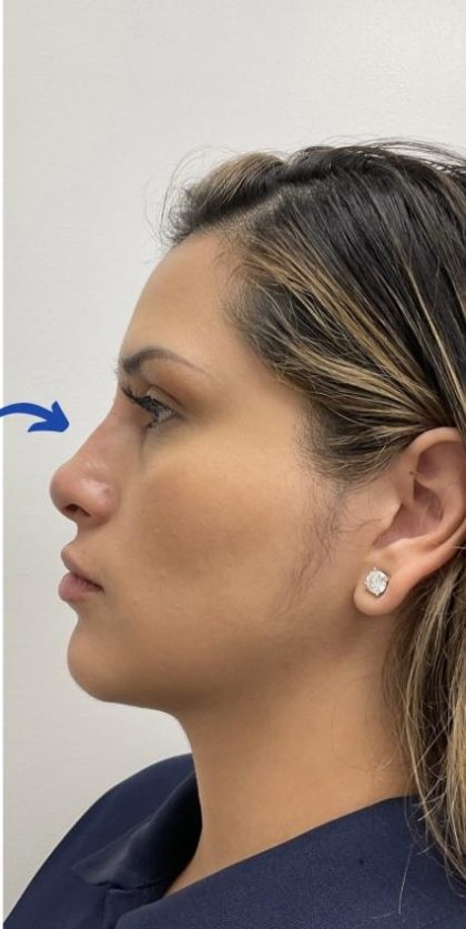 Non-Surgical Rhinoplasty Before & After Patient #3192