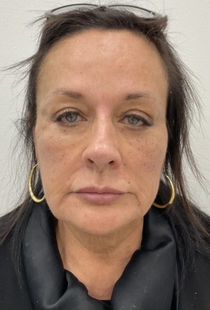 Full Face Enhancement (Botox + Filler Treatment) Before & After Patient #3177