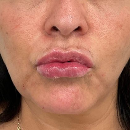 Lip Fillers Before & After Patient #3198