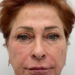 Full Face Enhancement (Botox + Filler Treatment) Before & After Patient #3181