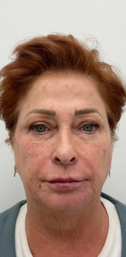 Full Face Enhancement (Botox + Filler Treatment) Before & After Patient #3181