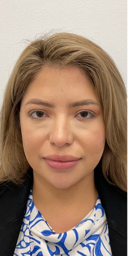 Non-Surgical Rhinoplasty Before & After Patient #3214