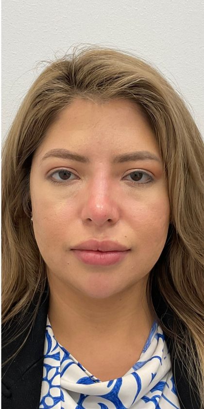 Non-Surgical Rhinoplasty Before & After Patient #3214