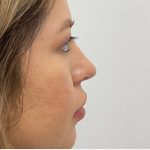 Non-Surgical Rhinoplasty Before & After Patient #3214