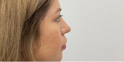 Non-Surgical Rhinoplasty Before & After Patient #3214