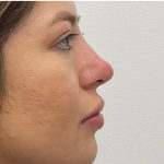 Non-Surgical Rhinoplasty Before & After Patient #3214