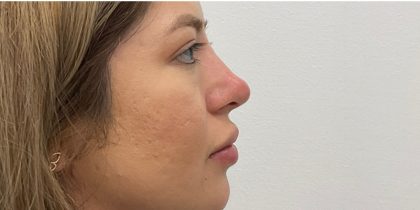 Non-Surgical Rhinoplasty Before & After Patient #3214