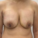 Breast Augmentation Before & After Patient #3226