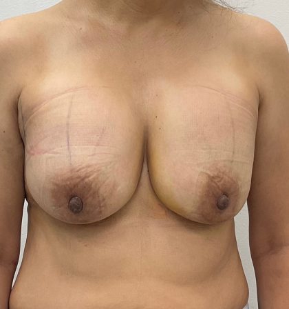 Breast Augmentation Before & After Patient #3226