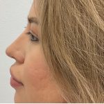 Non-Surgical Rhinoplasty Before & After Patient #3214