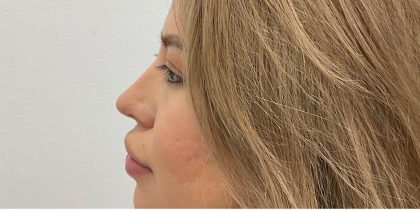 Non-Surgical Rhinoplasty Before & After Patient #3214