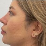 Non-Surgical Rhinoplasty Before & After Patient #3214