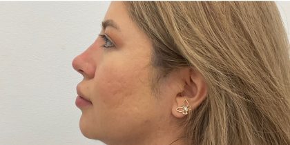 Non-Surgical Rhinoplasty Before & After Patient #3214