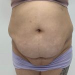 Fat Transfer Before & After Patient #3267