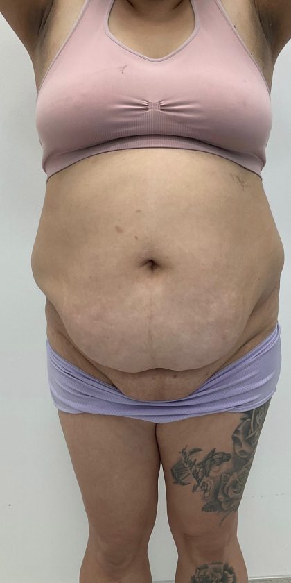 Fat Transfer Before & After Patient #3267