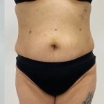 Fat Transfer Before & After Patient #3267