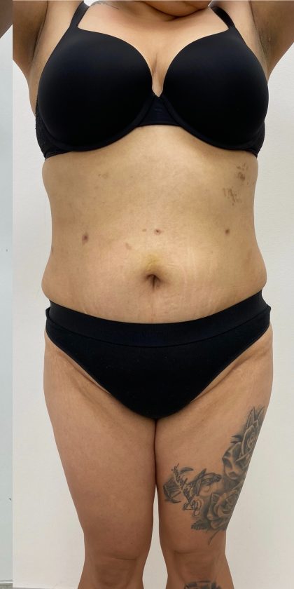 Fat Transfer Before & After Patient #3267