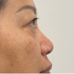 Non-Surgical Rhinoplasty Before & After Patient #3221