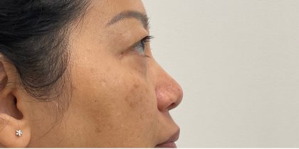 Non-Surgical Rhinoplasty Before & After Patient #3221