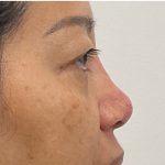 Non-Surgical Rhinoplasty Before & After Patient #3221