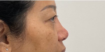 Non-Surgical Rhinoplasty Before & After Patient #3221