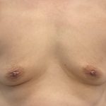 Breast Augmentation Before & After Patient #3229