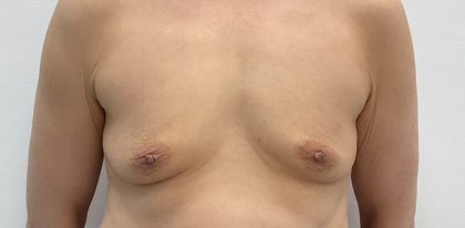 Breast Augmentation Before & After Patient #3229