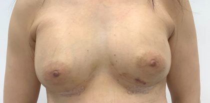 Breast Augmentation Before & After Patient #3229