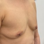 Breast Augmentation Before & After Patient #3229