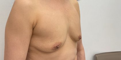 Breast Augmentation Before & After Patient #3229