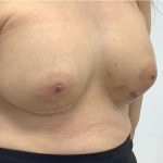 Breast Augmentation Before & After Patient #3229