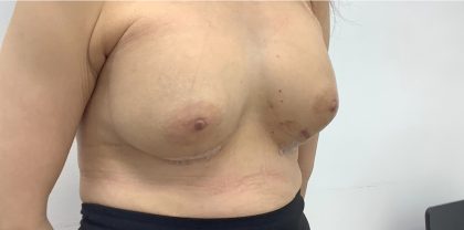 Breast Augmentation Before & After Patient #3229