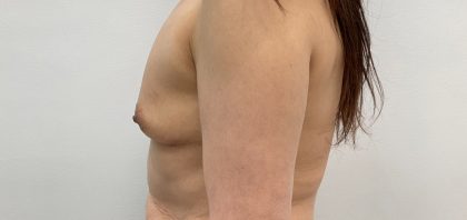 Breast Augmentation Before & After Patient #3229