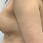 Breast Augmentation Before & After Patient #3229